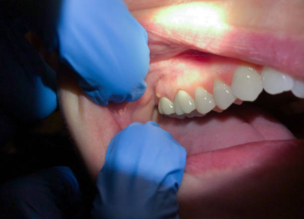 Best Knocked-Out Tooth (Avulsed Tooth) Treatment in Lake Arrowhead, ME